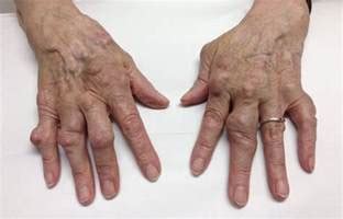 Efek Penyakit Artritis reumatoid